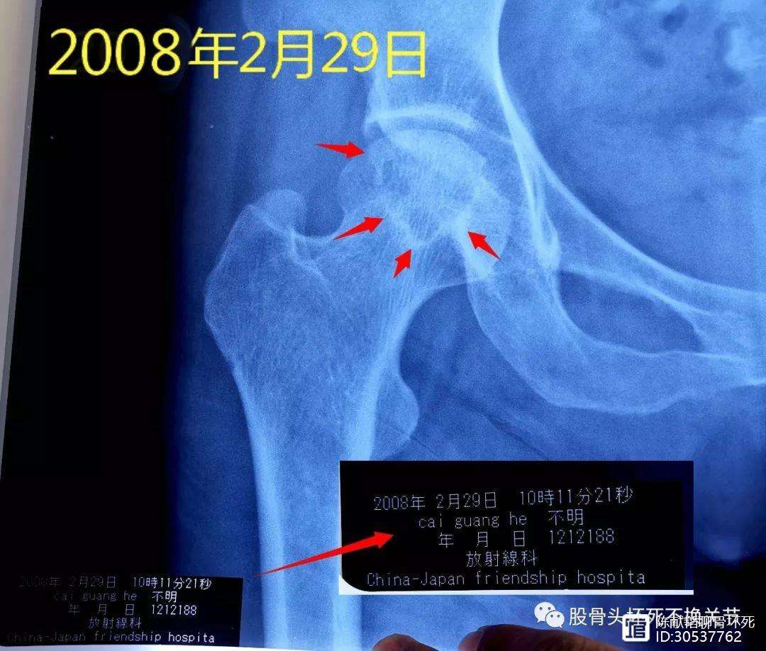 儋州人工骨头医保报销多少(人工骨头医保报销多少比例)